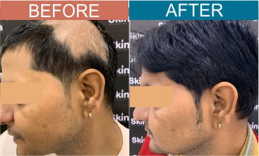 Alopecia-areata