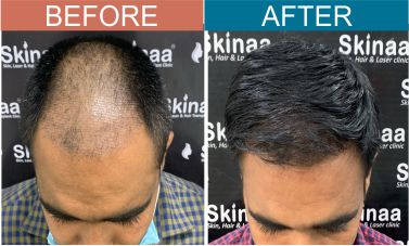 Hair-transplant