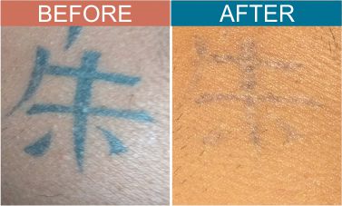 Laser-tatto-removal