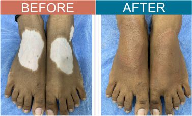 vitiligo-Micropigmentation