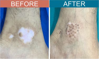 vitiligo-surgey