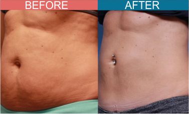 Best-Cryotherapy-Treatment-Skinaa-wellness1