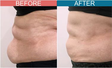 Best-Cryotherapy-Treatment-Skinaa-wellness3