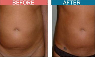 Best-Cryotherapy-Treatment-Skinaa-wellness4