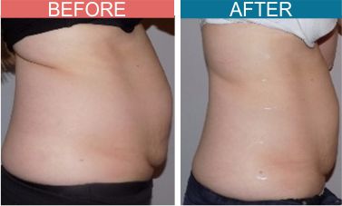 Best-Cryotherapy-Treatment-Skinaa-wellness5