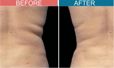 Best-Cryotherapy-Treatment-Skinaa-wellness6