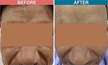 Botox-_-Fillers-Treatment-for-Anti-Aging-skinaa-clinic-before-after-2