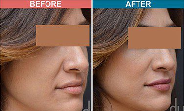 Botox-_-Fillers-Treatment-for-Anti-Aging-skinaa-clinic-before-after-5