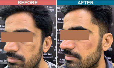 Carban-Laser-Facial-Treatment-For-Pigmentation-Before-After-Skinaa-Clinic-2