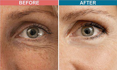 MESOTHERAPY-Treatment-For-Pigmentation-Skinaa-Clinic-3