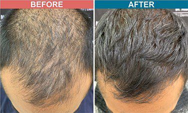 PRP-with-Derma-roller-treatment-skinaa-clinic-before-after-1