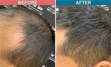 PRP-with-Derma-roller-treatment-skinaa-clinic-before-after-2