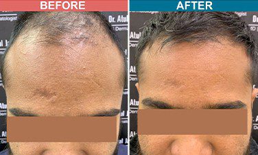 PRP-with-Derma-roller-treatment-skinaa-clinic-before-after-3