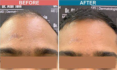 PRP-with-Derma-roller-treatment-skinaa-clinic-before-after-4