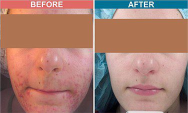 Peel-Treatment-For-Skin-Lightenign_Whitening-Before-After-Skinaa-Clinic-2