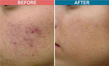 Peel-Treatment-For-Skin-Lightenign_Whitening-Before-After-Skinaa-Clinic-5