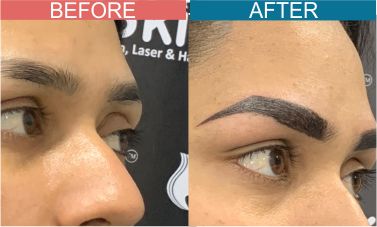 Permanent-Cosmetics-Treatment-skinaa-clinic1