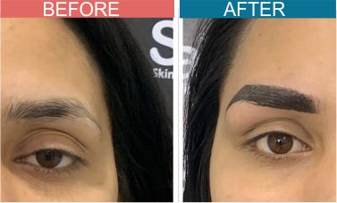Permanent-Cosmetics-Treatment-skinaa-clinic2