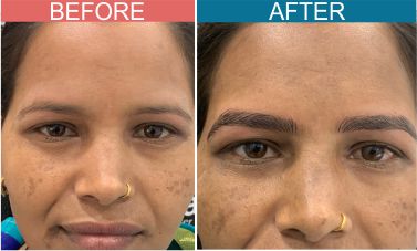 Permanent-Cosmetics-Treatment-skinaa-clinic3