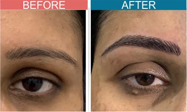 Permanent-Cosmetics-Treatment-skinaa-clinic4