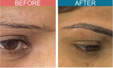 Permanent-Cosmetics-Treatment-skinaa-clinic5