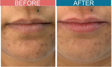 Permanent-Cosmetics-Treatment-skinaa-clinic6