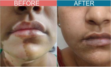 Punch-grafting-treatment-skinaa-clinic2