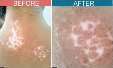 Punch-grafting-treatment-skinaa-clinic6