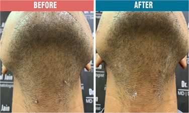 Wart-Removal-Treatment-Skinaa-Clinic-Before-After-3