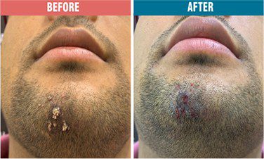 Wart-Removal-Treatment-Skinaa-Clinic-Before-After-4