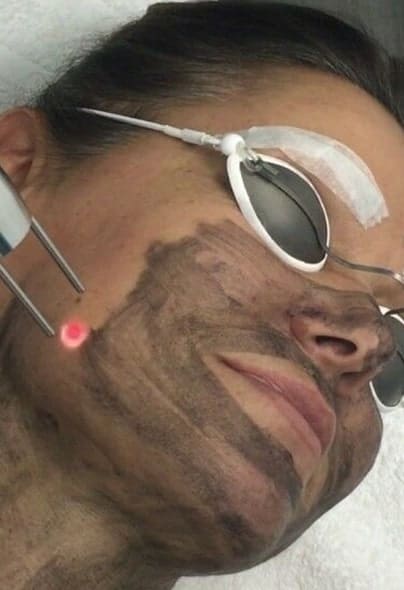 carban-laser-facial-1