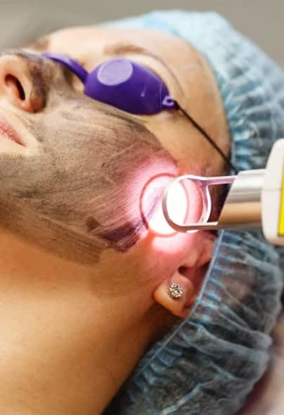 carban-laser-facial-2