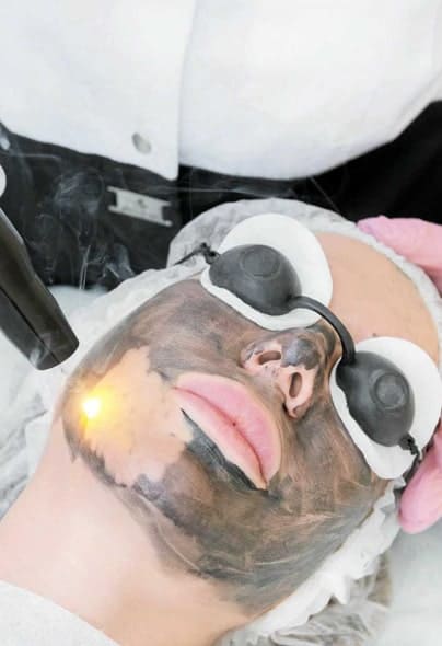 carban-laser-facial-4