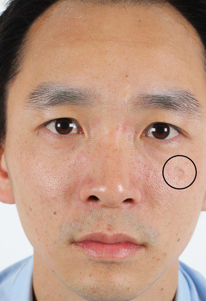 co2-fractional-laser-2