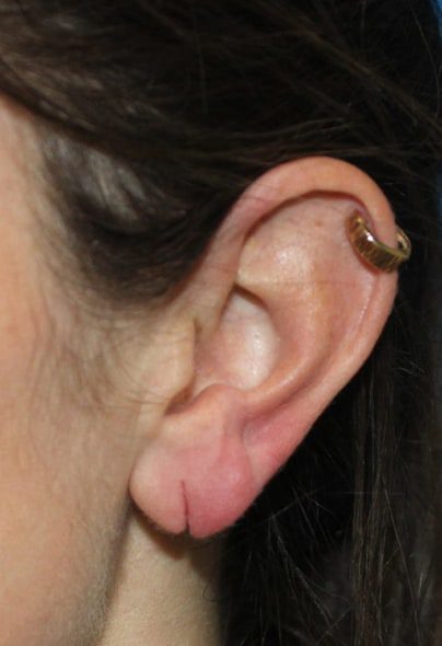 earlobe-repair-1