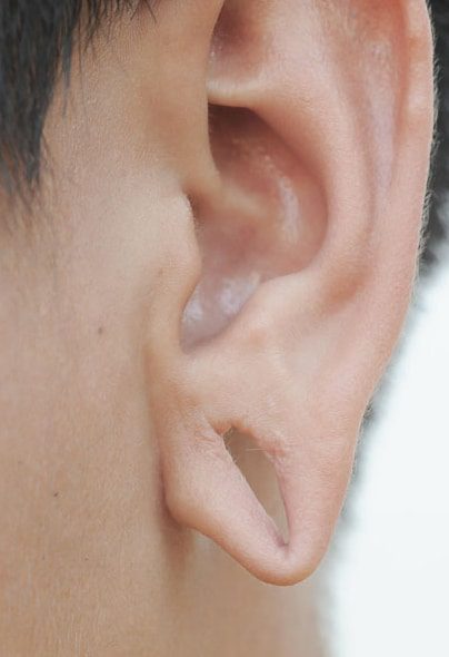 earlobe-repair-2
