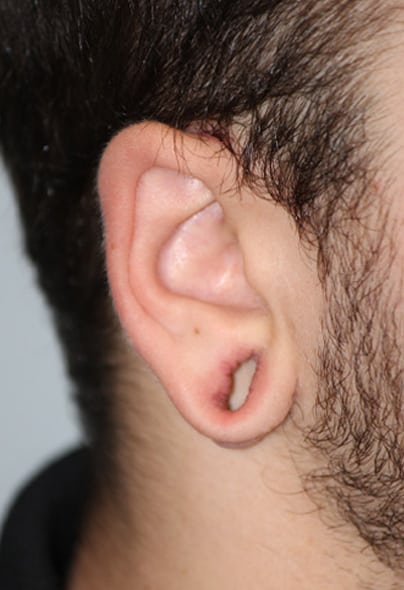 earlobe-repair-3