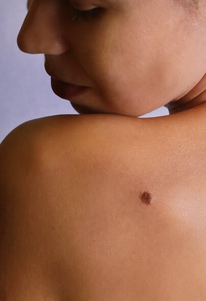 mole-removal-treatment-1