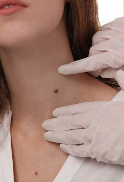 mole-removal-treatment-2