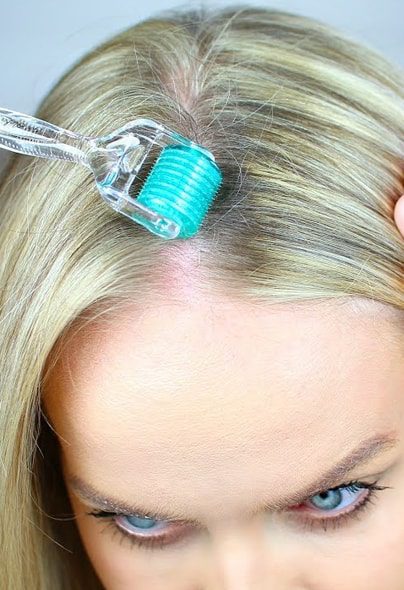 prp-dermaroller-treatment-1