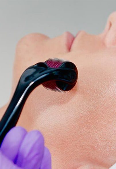 prp-dermaroller-treatment-2 (1)