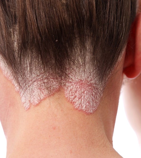 psoriasis-1