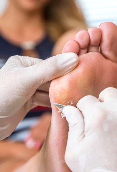 wart-removal-treatment-1