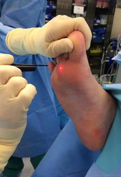 wart-removal-treatment-3